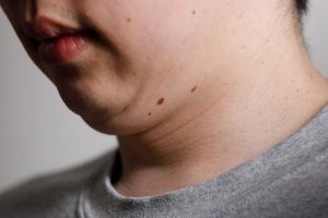 二重顎の原因を徹底解説｜セルフチェックリストや二重顎を解消する方法なども紹介