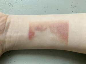 ボルニューマで火傷することはある？効果・痛み・リスクと安全に受けるためのポイントを徹底解説