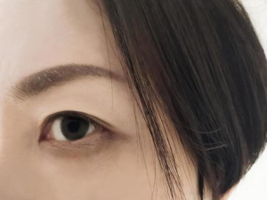 ジャルプロは目の下のクマ・しわに効果ある？ダウンタイムの経過やヤングアイの特徴を解説