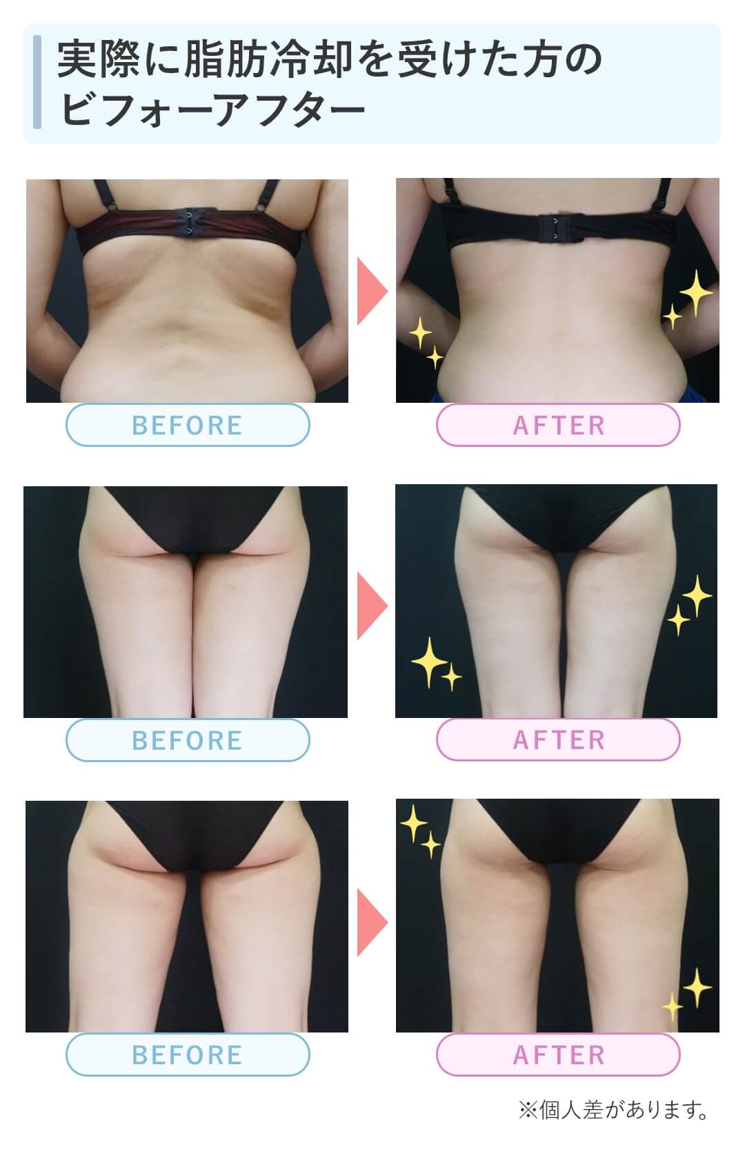 実際に脂肪冷却を受けた方のビフォーアフター