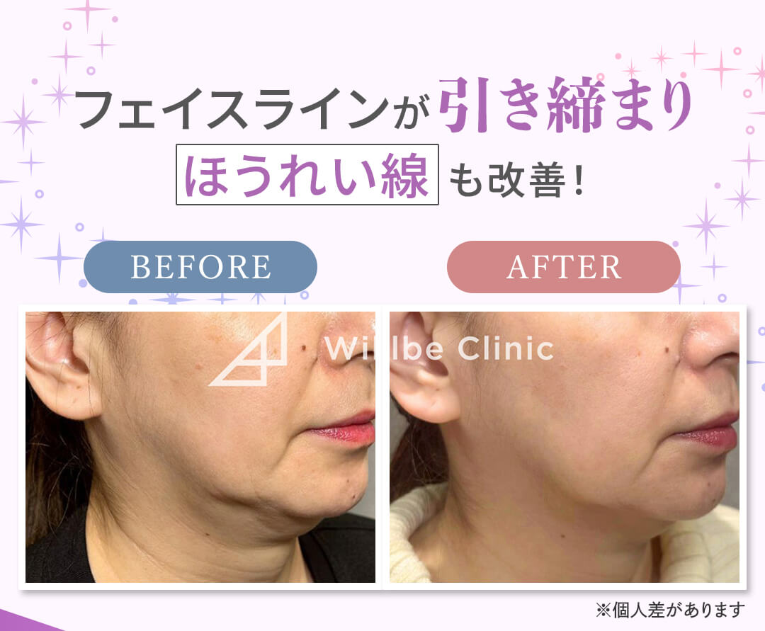 フェイスラインが引き締まりほうれい線も改善！