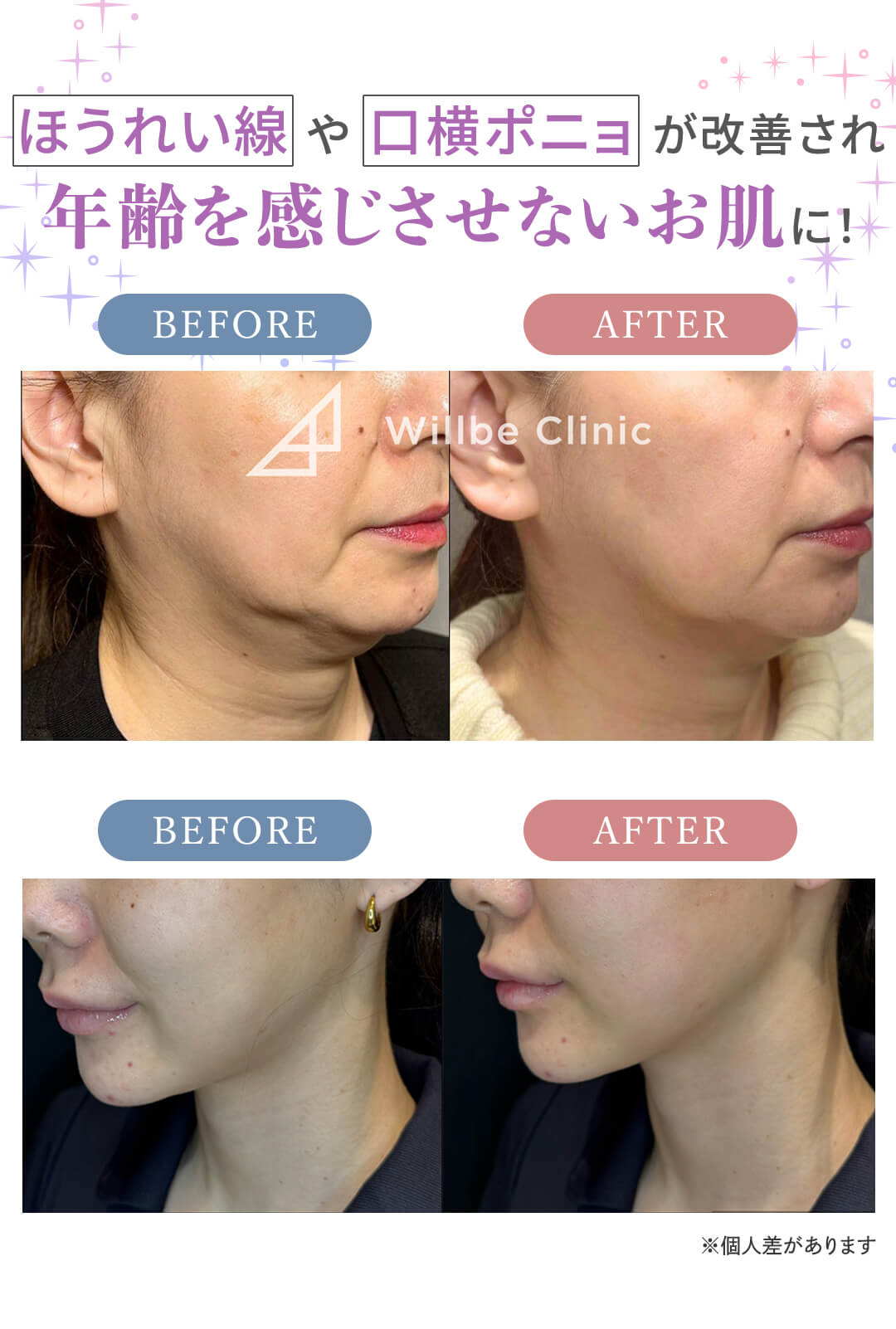 ほうれい線や口横ポニョが改善され年齢を感じさせないお肌に！