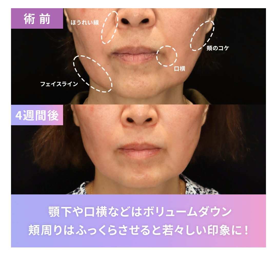 顎下や口横などはボリュームダウン 頬周りはふっくらさせると若々しい印象に！